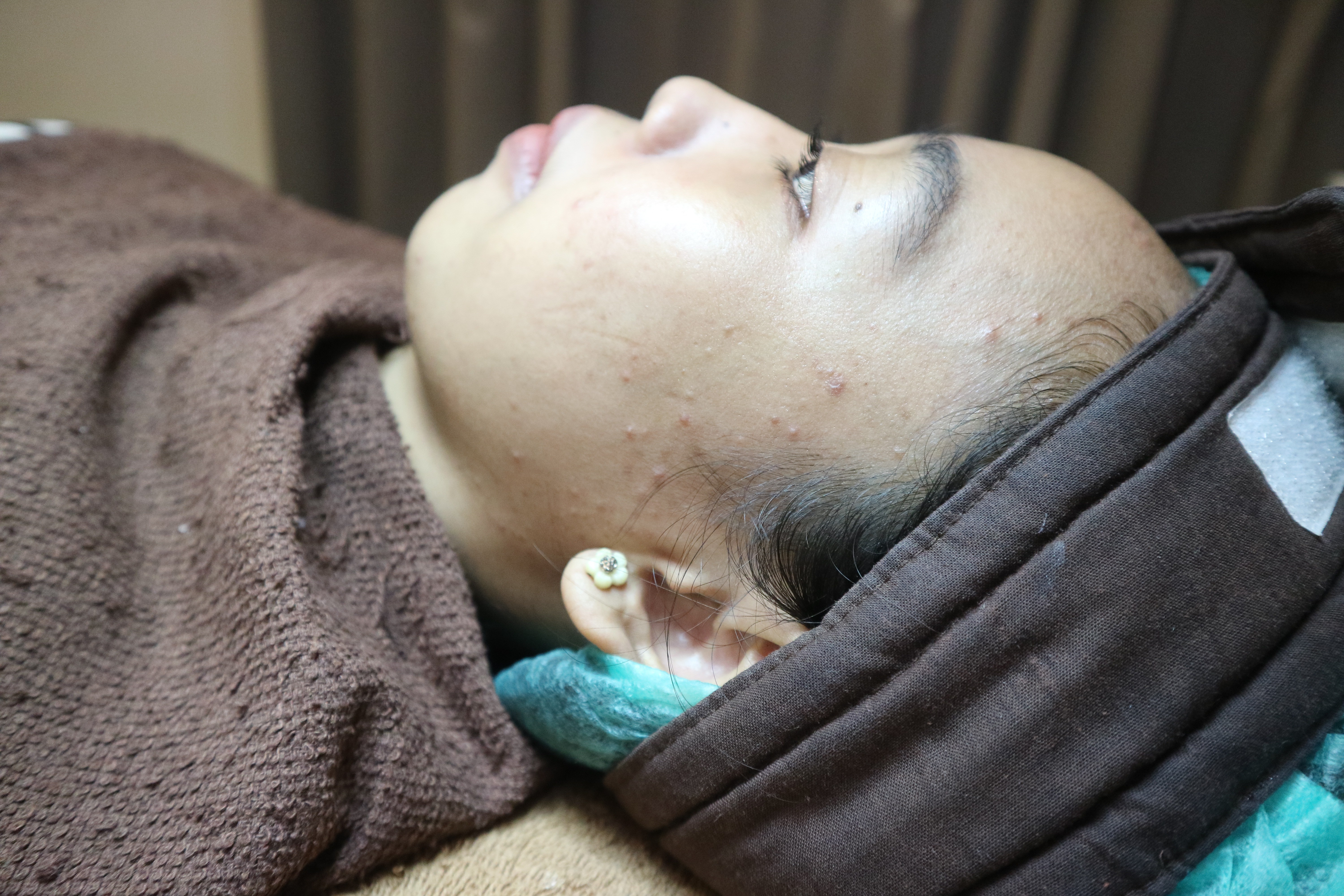Acne vulgaris after cleaning Object Detection Dataset by Acne Severity