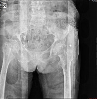 femur project thumbnail