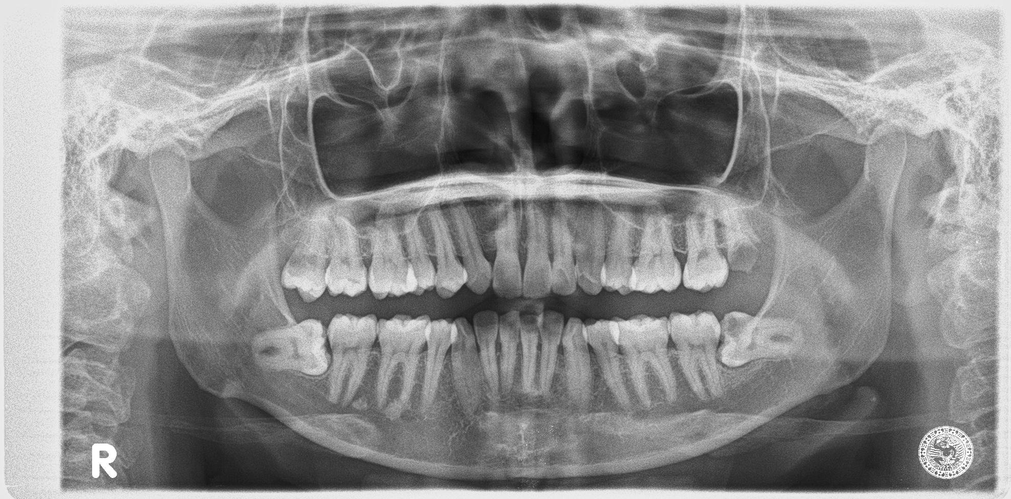 Horizontal Bone Loss Detection Object Detection Dataset and Pre-Trained ...