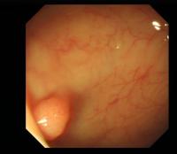 Polypdetection project thumbnail