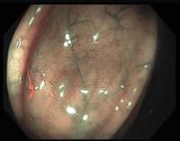 Polyp_det project thumbnail