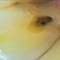 dental_caries project thumbnail
