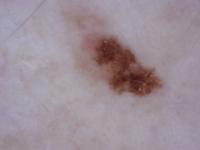 Skin Cancer project thumbnail