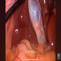 Lapro Segmentation project thumbnail
