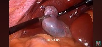 laproscopic surgery  project thumbnail