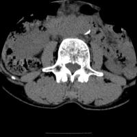 Myostéatose project thumbnail