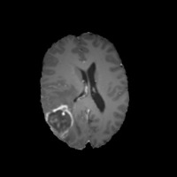 Brain Tumor Detection project thumbnail