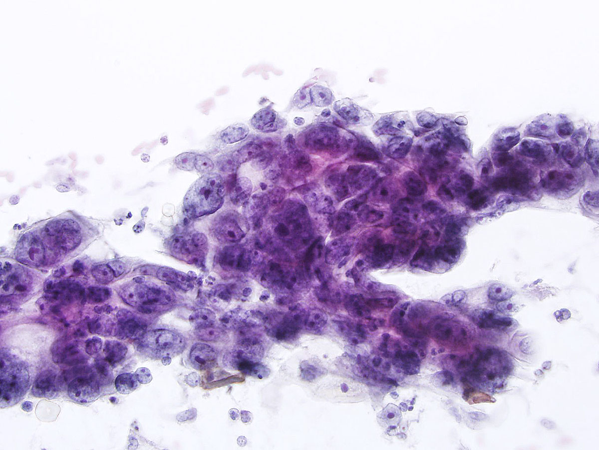 ASC-US Object Detection Dataset by Cervical Cancer