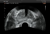 Cancer project thumbnail