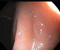 polyps-batch-1 project thumbnail