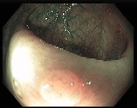 polyps-batch-2 project thumbnail
