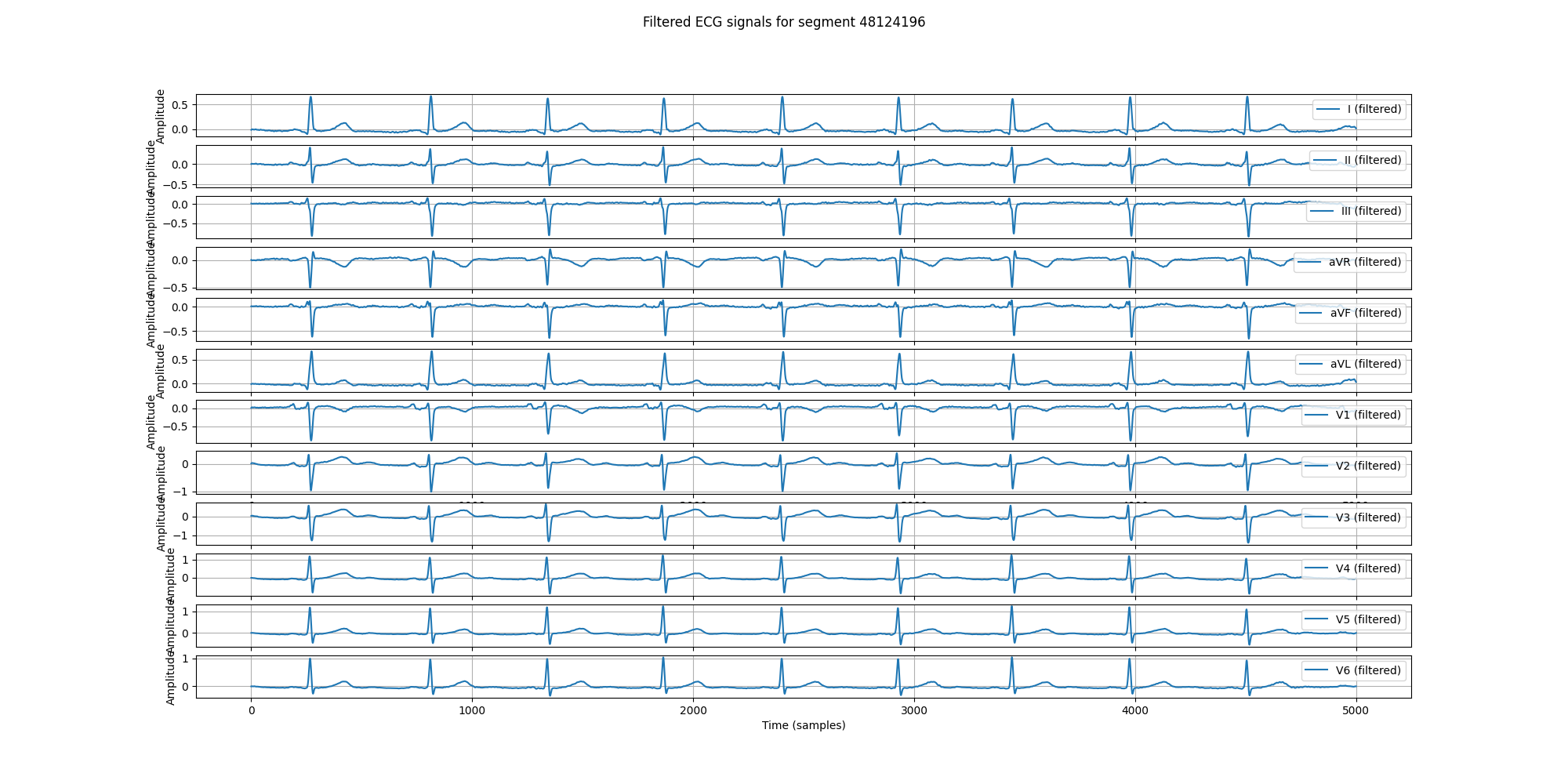 Hyperkalemia-Normal Classification Dataset by Arrythmia