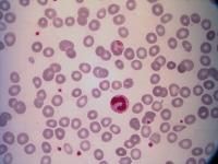 malaria detection project thumbnail
