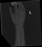 FractureVision project thumbnail