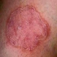 Ringworm Classification Model by projectslikeneverbeforejk