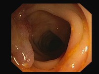 Colonoscopy project thumbnail