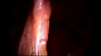 Surgical tool recognition project thumbnail