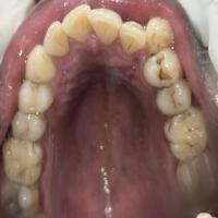 maxillary project thumbnail