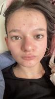 Hyperpigmentation project thumbnail