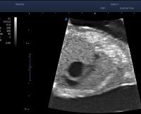 Right ventricular outflow tract project thumbnail