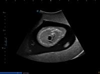 Right ventricular outflow tract project thumbnail