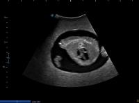 Left ventricular outflow tract c project thumbnail