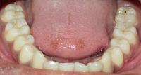 Mandibular project thumbnail