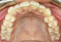 Maxillary project thumbnail