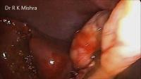 Laparoscopic Cholecystectomy project thumbnail