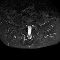 Sacroiliitis project thumbnail