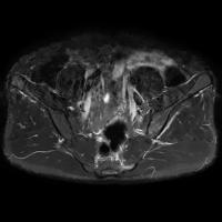 patient1144241313 Sacroilitis project thumbnail