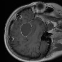 OriProtoTumor1 project thumbnail