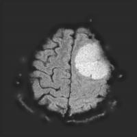 RetinexTumor project thumbnail