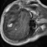 tumor1poly project thumbnail