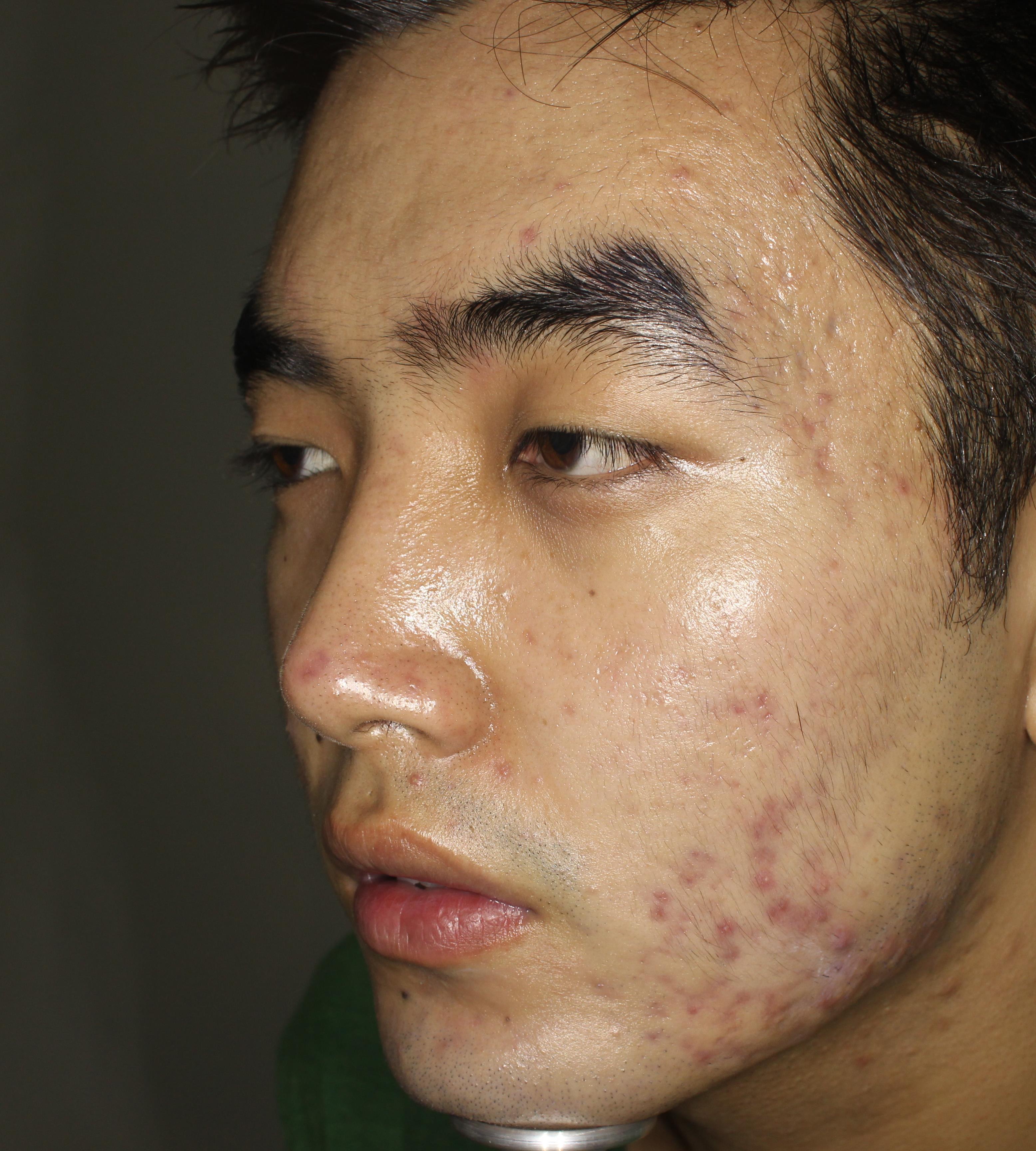 How to Use the acne Object Detection API