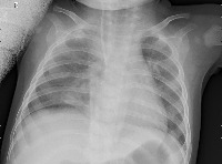 PNEUMONIA project thumbnail
