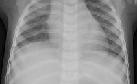 pneumonia and normal  project thumbnail