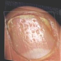 Stage 2 Nail Disease Classify project thumbnail