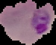 Malaria vs. Uninfected project thumbnail