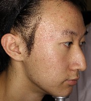 acne04 project thumbnail