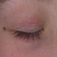 Dermnet_s project thumbnail