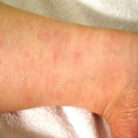 Skin-Burn project thumbnail