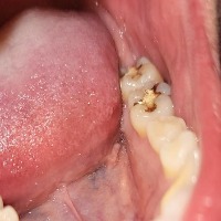 tooth detection project thumbnail