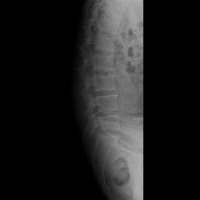 Lumbar Spondylolisthesis project thumbnail