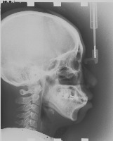 cephalometric landmarks Object Detection Model by CEPHALO