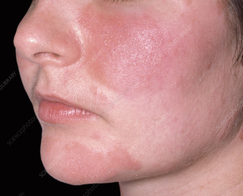 Rosacea redness and flushing