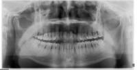 furcation detection project thumbnail