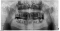 bone loss detection project thumbnail