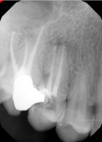 periapical-index-2nd project thumbnail