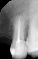 Periapical Index project thumbnail